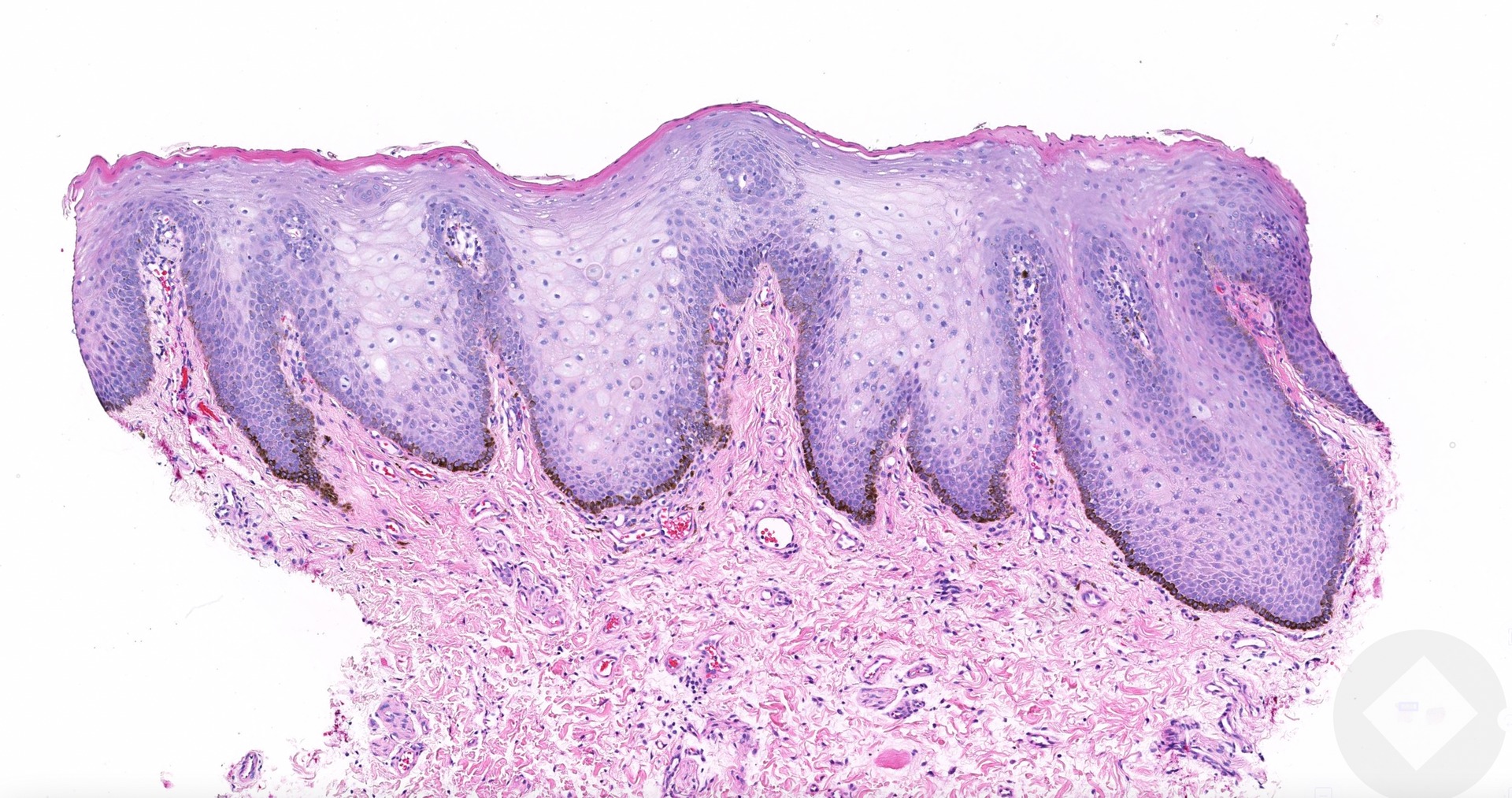 What is the diagnosis of a 4mm dark brown macule on the lower lip?