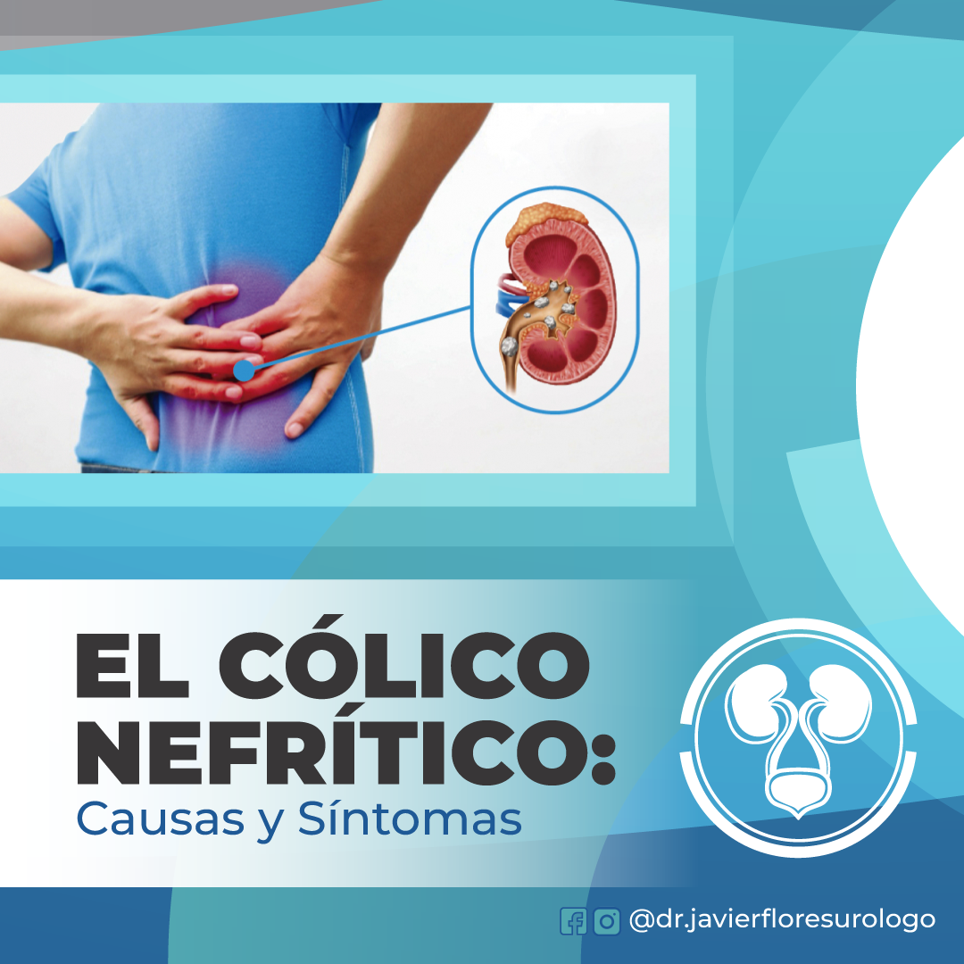 Javier - 👨🏻‍⚕️😩 La causa principal del cólico nefrítico es la presencia ...