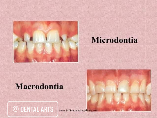 Dr. - ¿Qué es la microdoncia y la macrodoncia? La microdoncia y la ...
