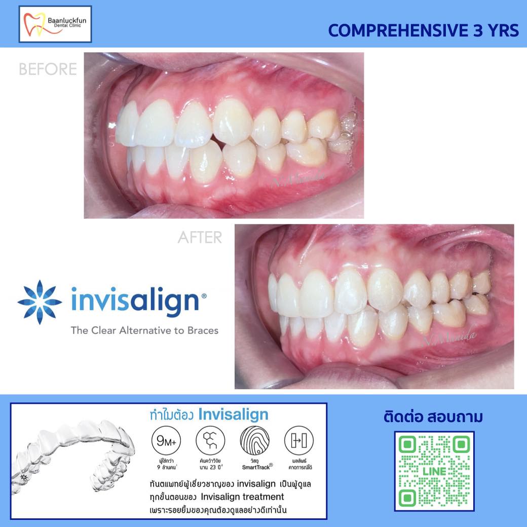คลินิกบ้านรักฟัน - #จัดฟันใส#Invisalign เคสจัดฟันรอบสอง เนื่องจากรู้สึก ...