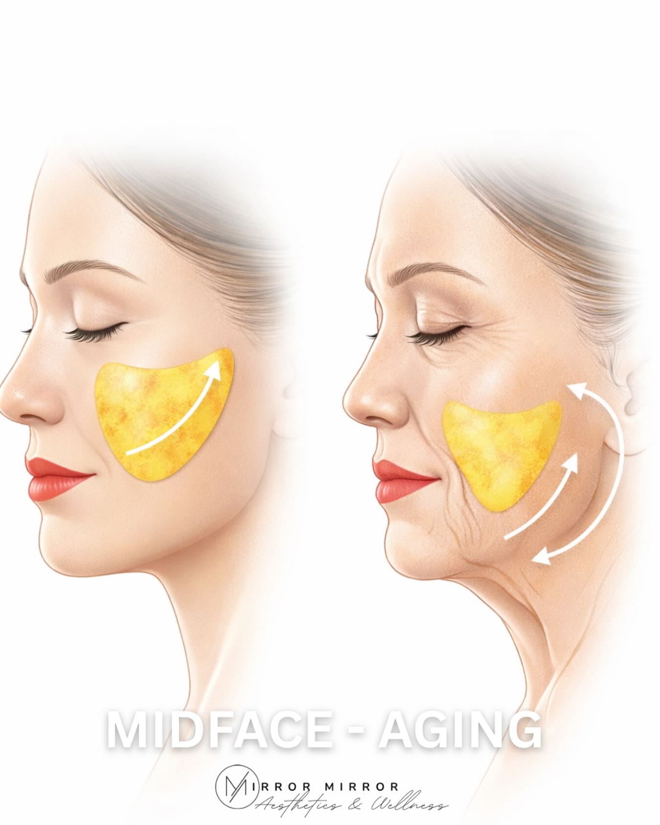 Mirror - MID-FACE AGING 101 Ever wonder why cheeks look flatter over ...