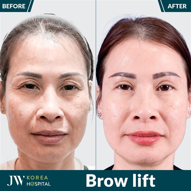 JW - JW HOSPITAL HELPS U50 WOMAN LOOK 10 YEARS YOUNGER WITH BROW LIFT ...