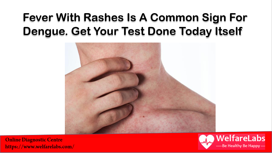 Welfarelabs - Rashes In Fever Is A Common Sign For Dengue... | Facebook