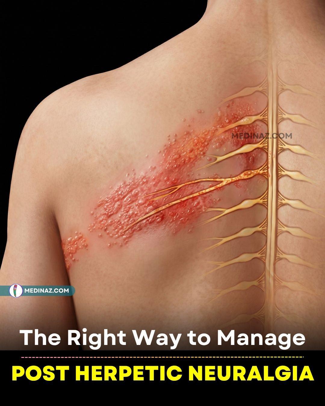 🟣 What is postherpetic neuralgia? ➟ Postherpetic neuralgia, often called PHN, is the long-lasting nerve pain that can remain after a shingles rash has healed. ➟ It is the most common complication