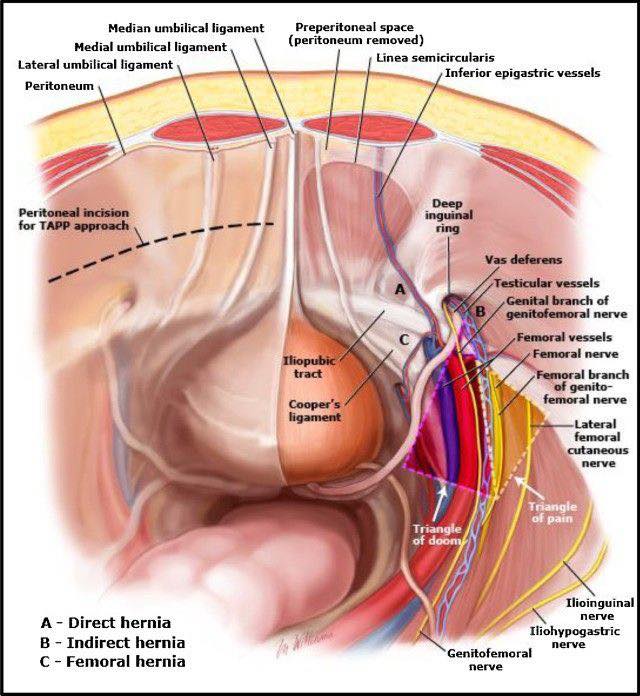 Dr. Muhammed - Direct and Indirect Hernia | Facebook