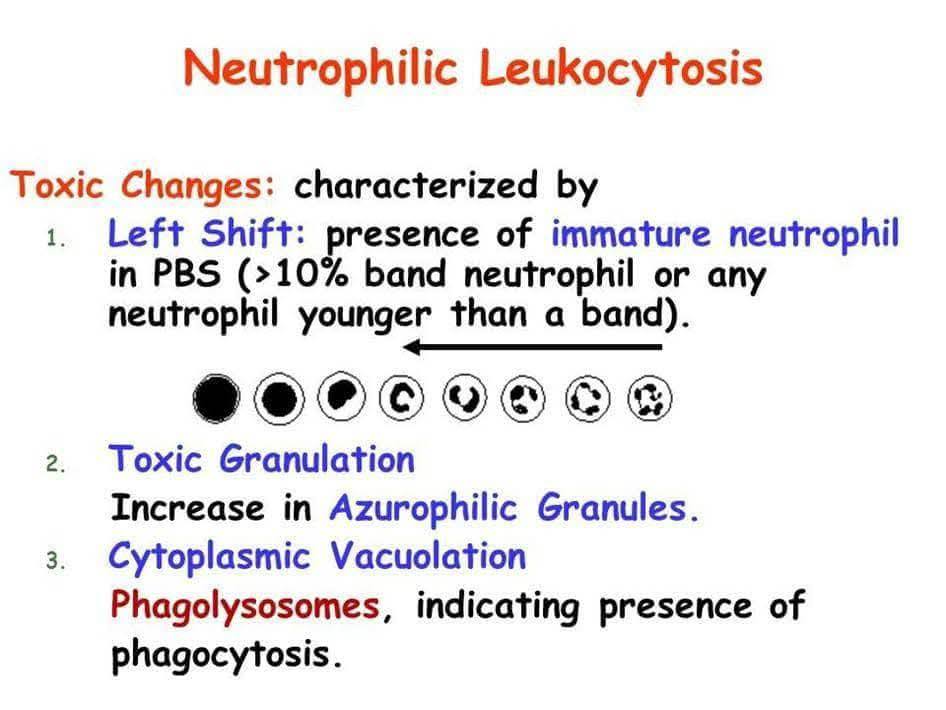 MED LAB ZONE - 💐 “Left Shift” in Neutrophils 💐 🍁 A Left... | Facebook
