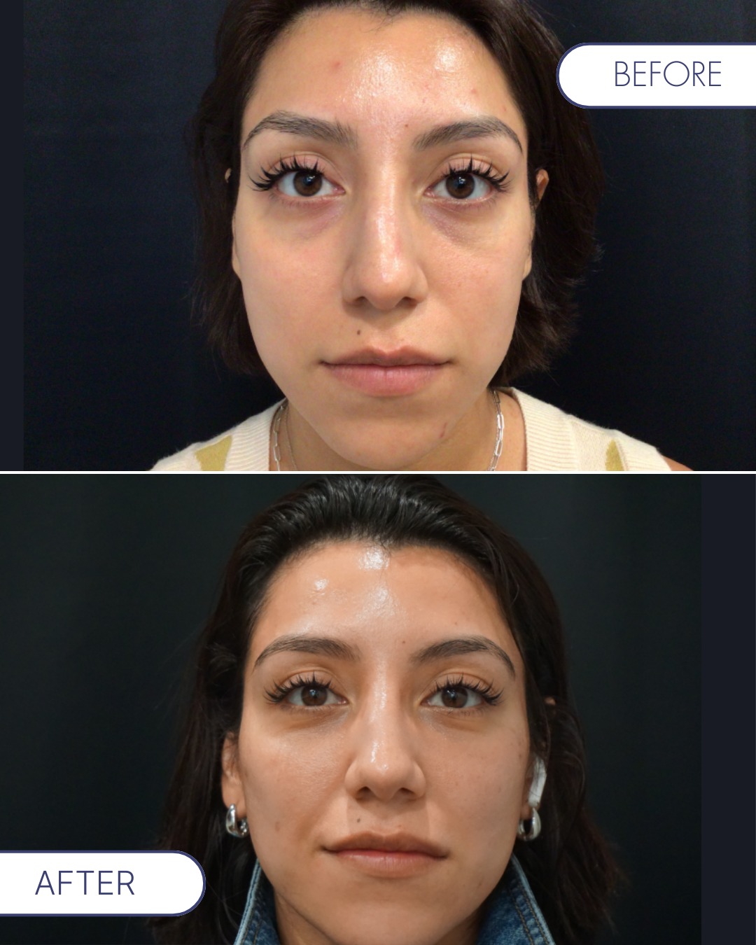 RL - Before → After Facial fat transfer by Dr. Ritacca to support ...