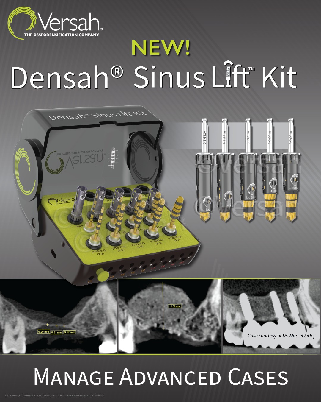 Versah, - Manage your advanced sinus cases with Versah®'s NEW Densah ...