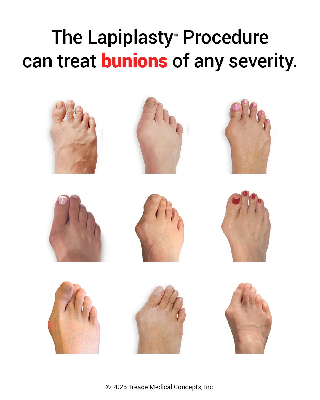 Lapiplasty 3D Bunion Correction | Ponte Vedra FL