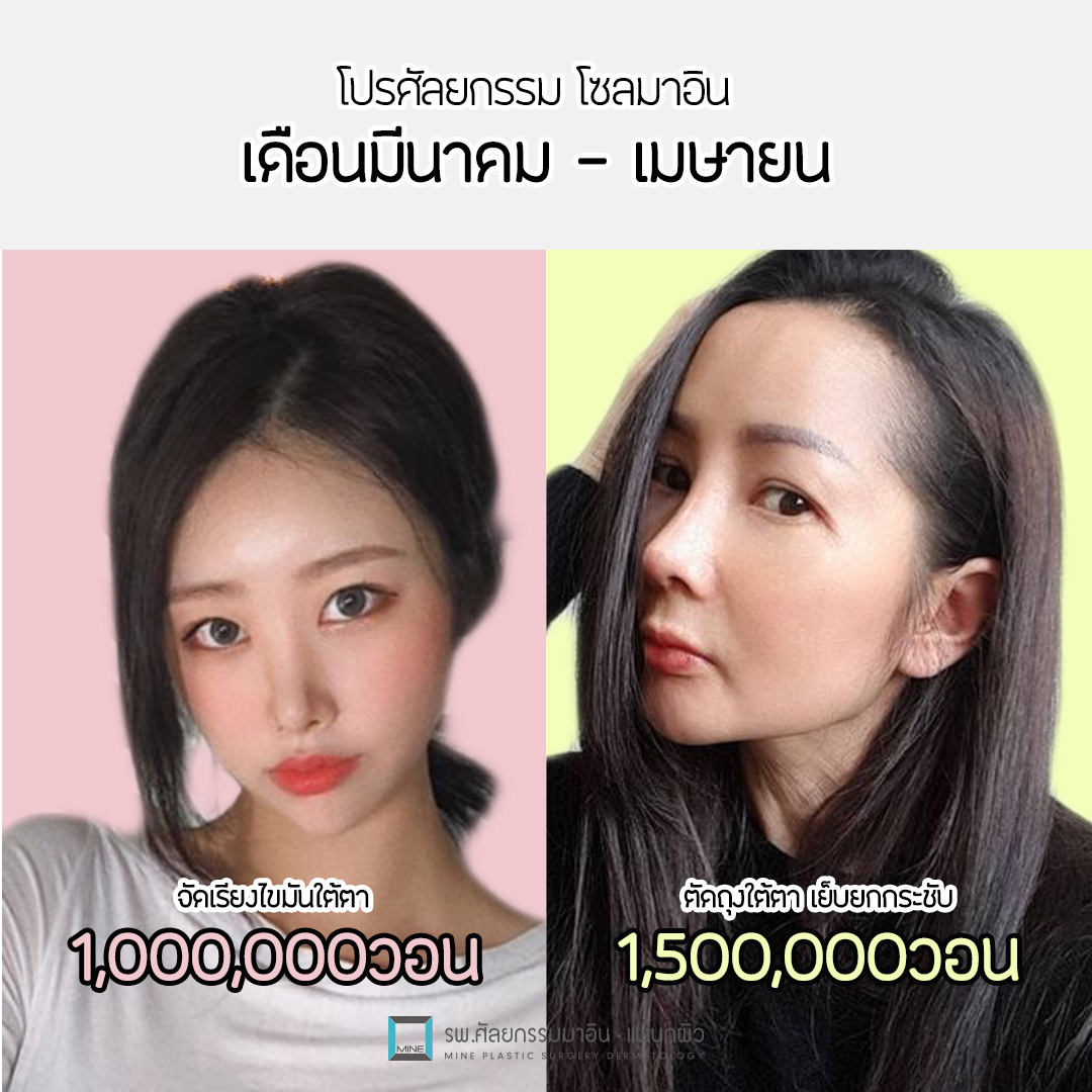 📢... - Seoul MINE Plastic Surgery โรงพยาบาลศัลยกรรม โซลมาอิน
