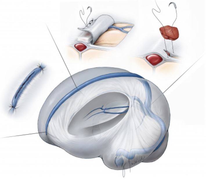 The Neurosurgical - #SuperiorSaggitalSinus repair management depends on ...