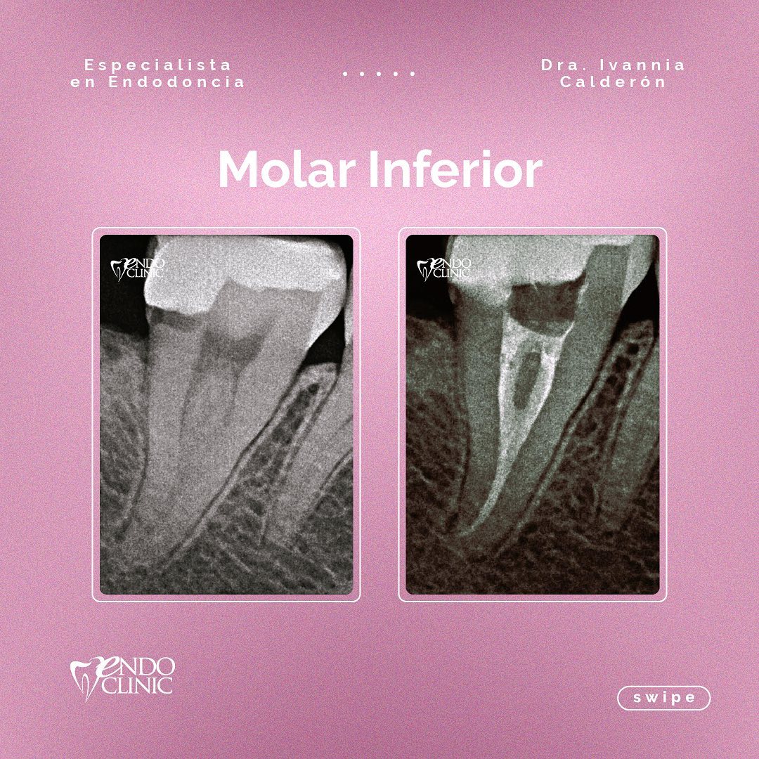 🦷 Micro-Endodoncia en pieza... - Dra Ivannia Calderón Deliens