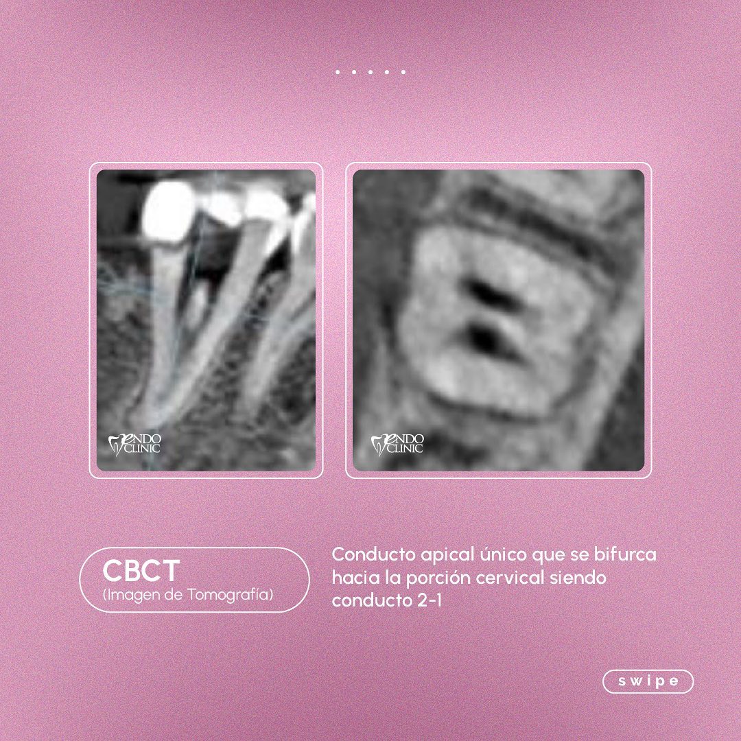 🦷 Micro-Endodoncia en pieza... - Dra Ivannia Calderón Deliens