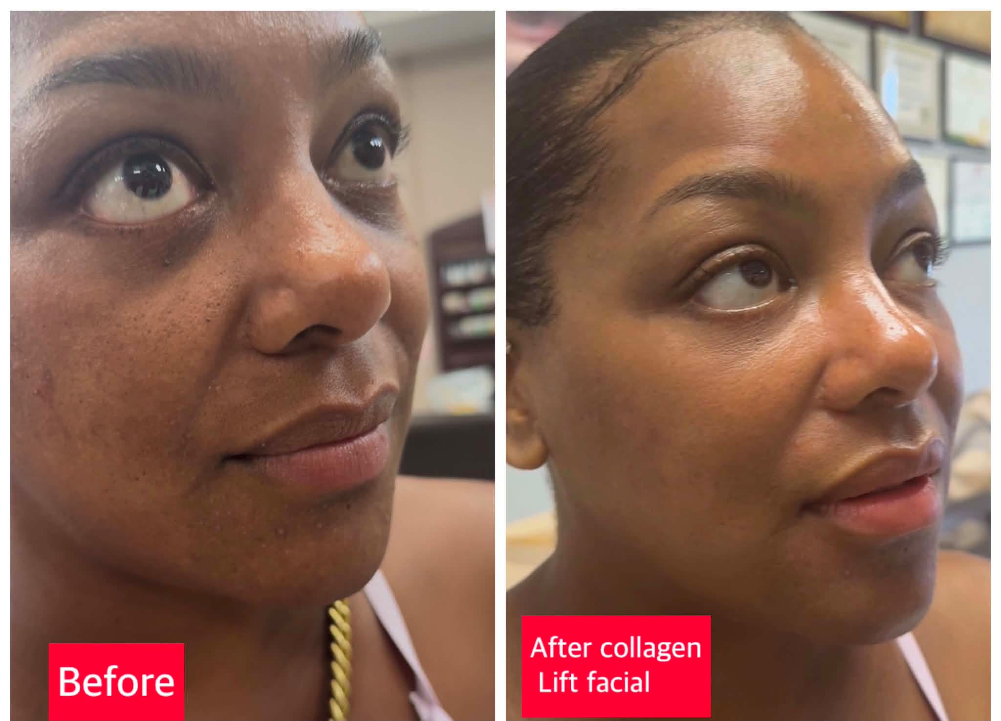 black skin glutathione drip before and after BEAUTY CARE THAT BECOMES PART OF YOUR ROUTINE. ✨ IV Collagen supports hydration elasticity while complementing your overall wellness routine for skin that looks healthier, smoother, and more refreshed. 💜 Size:2 Grams