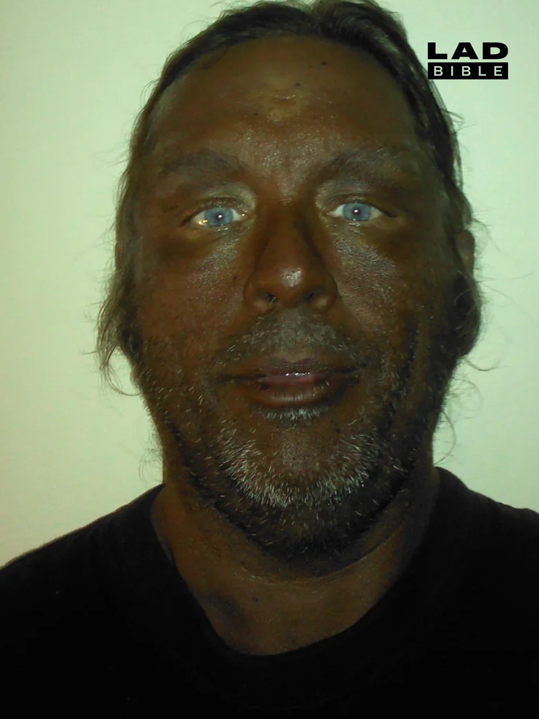 melanotan peptide before and after pictures A man looks completely unrecognisable injecting himself with synthetic II for several years 😮 Also referred to as the 'Barbie drug', it's a synthetic hormone-like peptide which is either tumeric Flavor:Banana Foster Waffle Sundae Evogen Carnigen Liquid 3000
