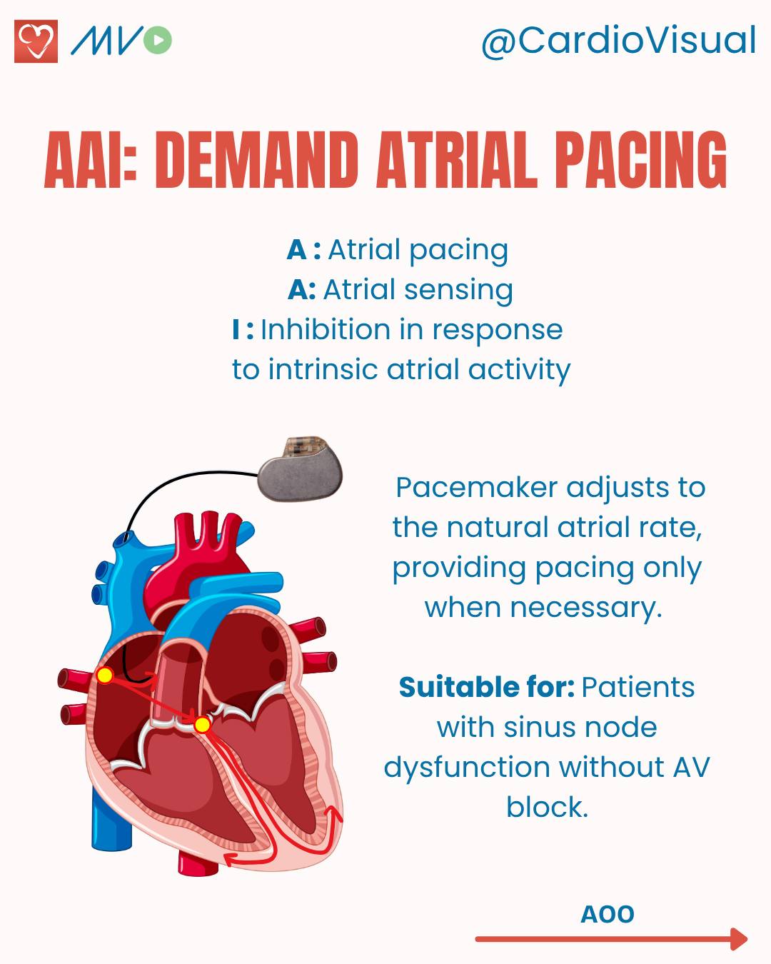 CardioVisual - A pacemaker employs various modes and... | Facebook