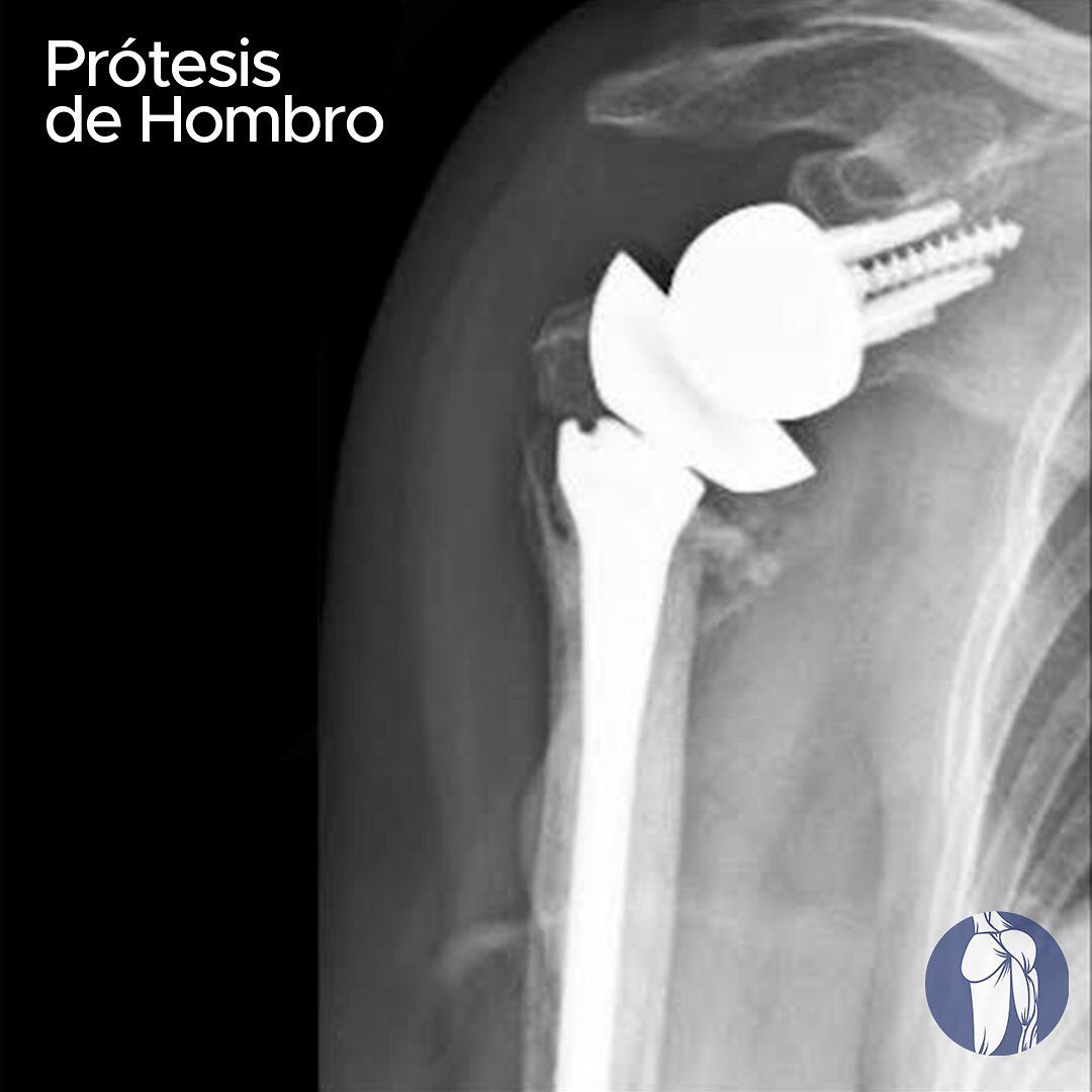 La fractura de húmero proximal es la tercera fractura mas frecuente en ...