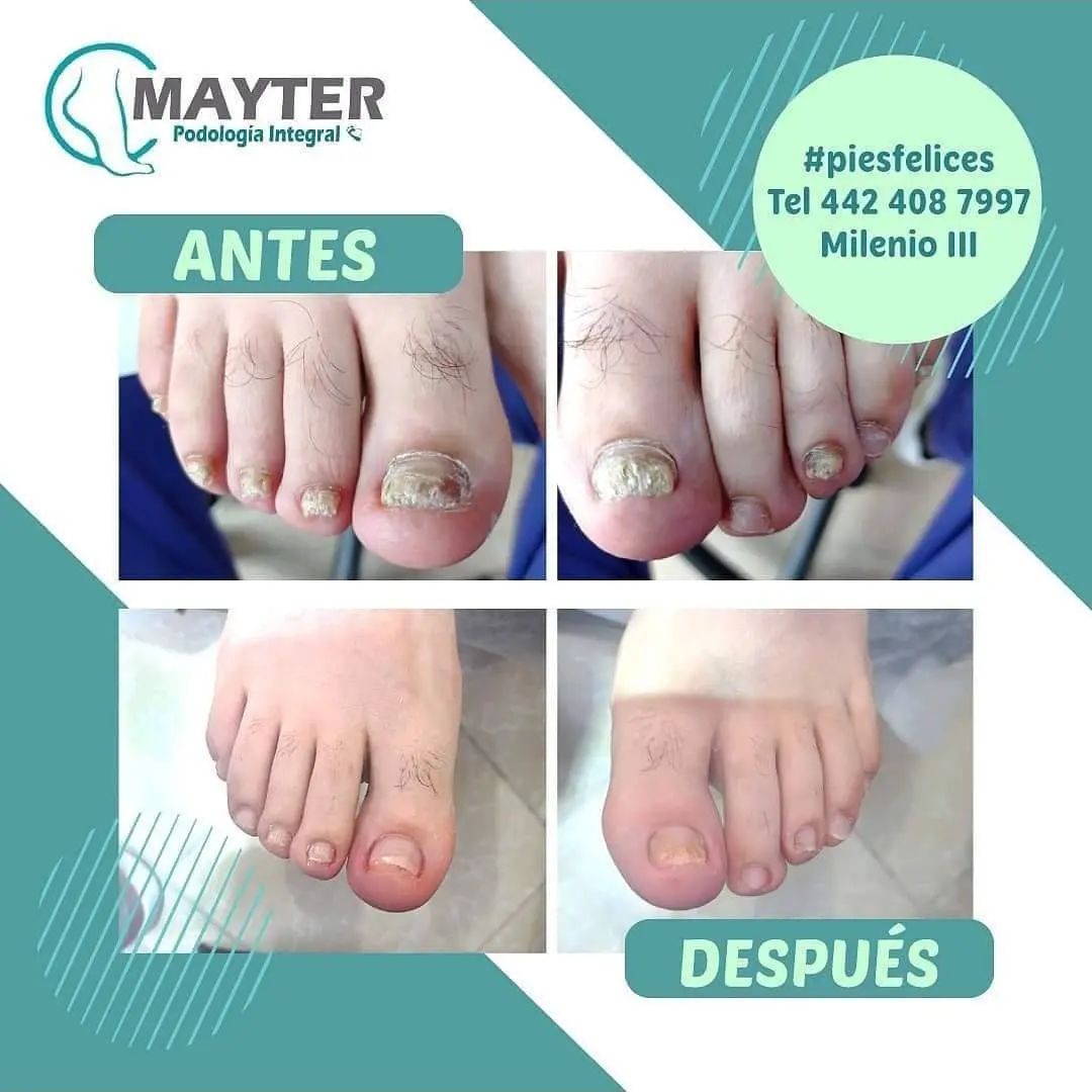 La... - Podologia Integral Mayter Enfermera y Podologa