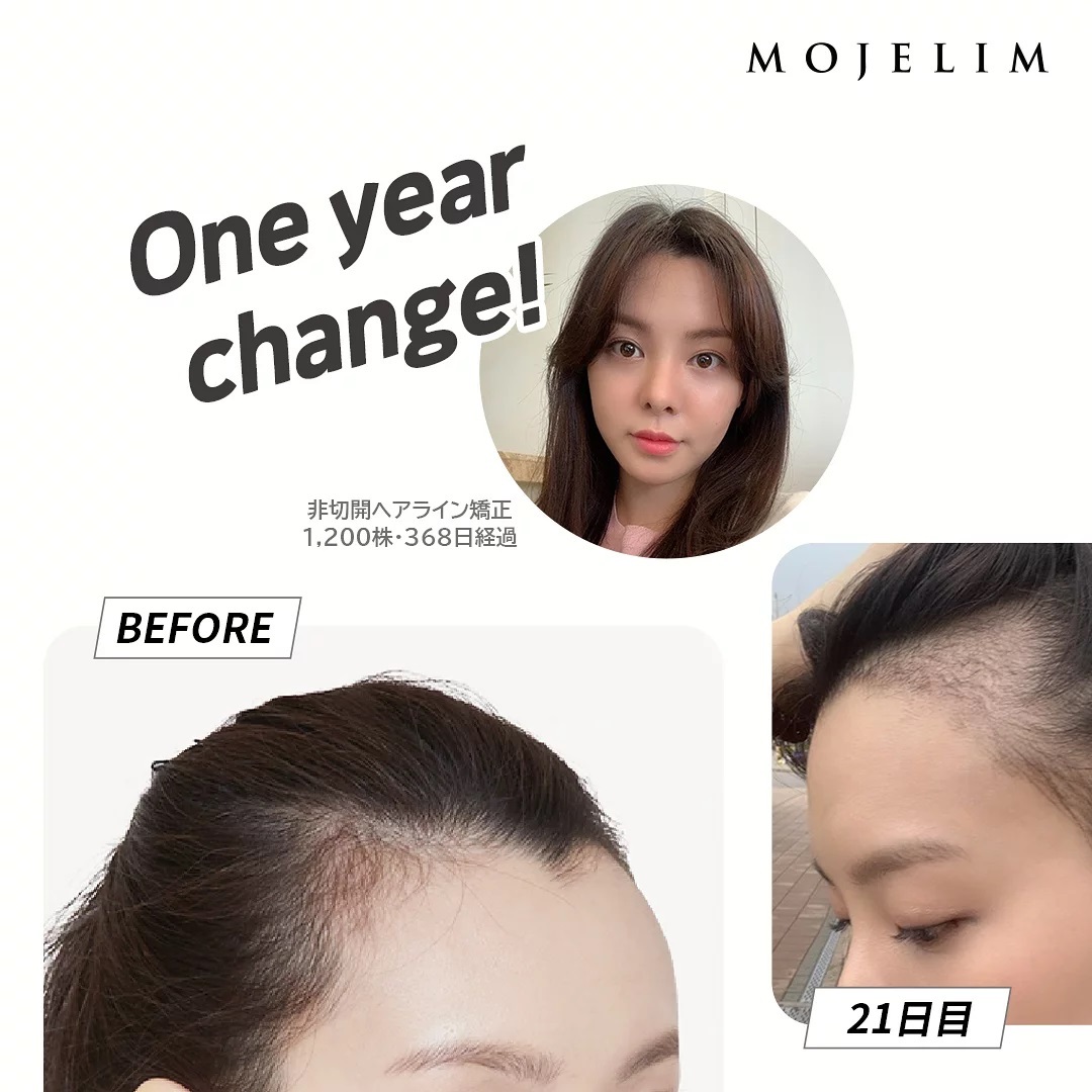 モジェリムクリニック 非切開ヘアライン矯正 手術前から368日までの変化 Facebook