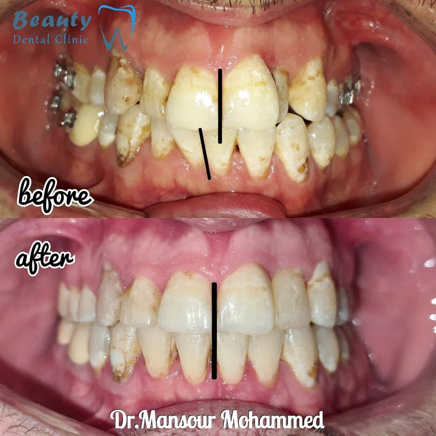 راستكردنه وه ی ددان بو چاره خوازیک... - Beauty Dental Center