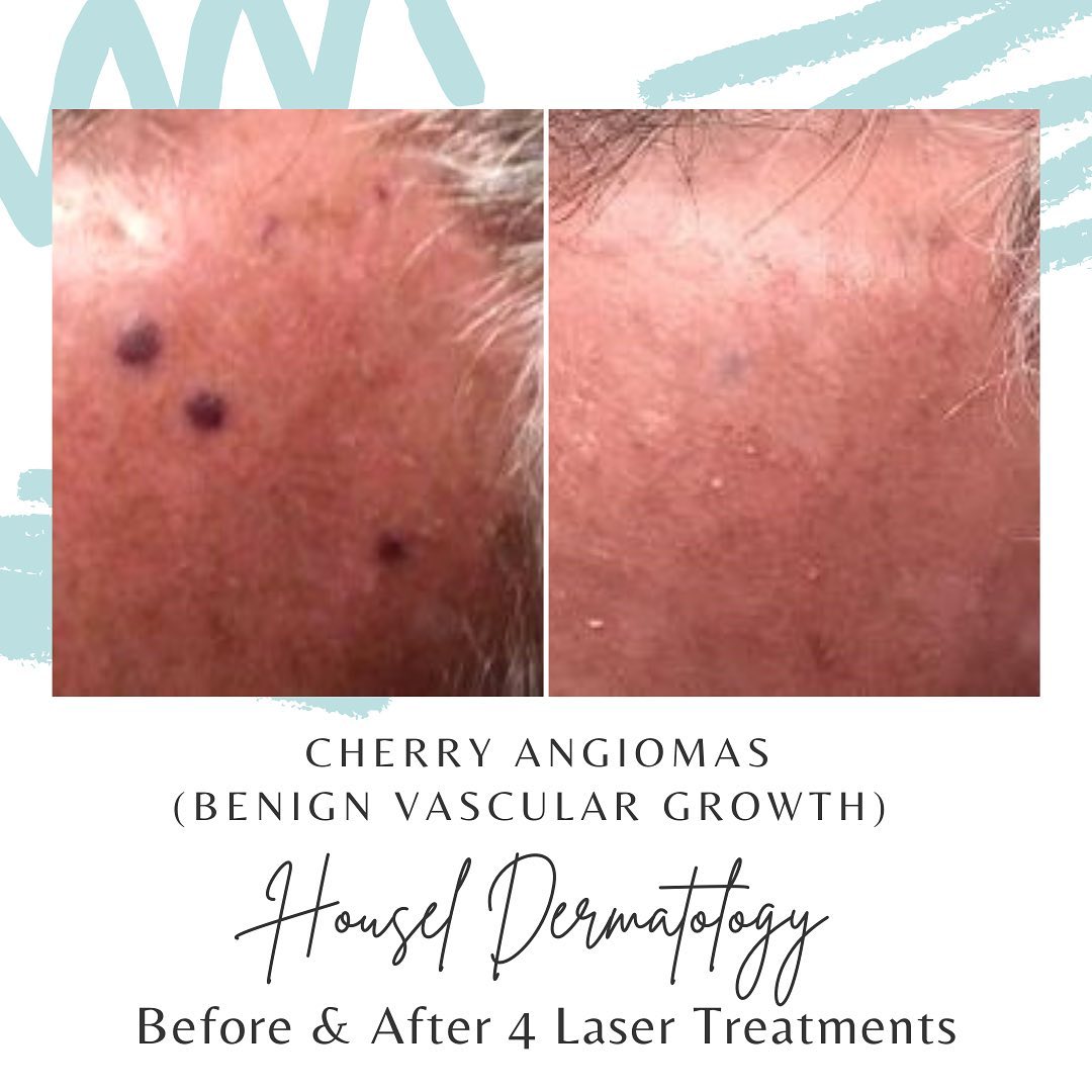 Laser can treat: • Broken... - Housel Dermatology, P.C.