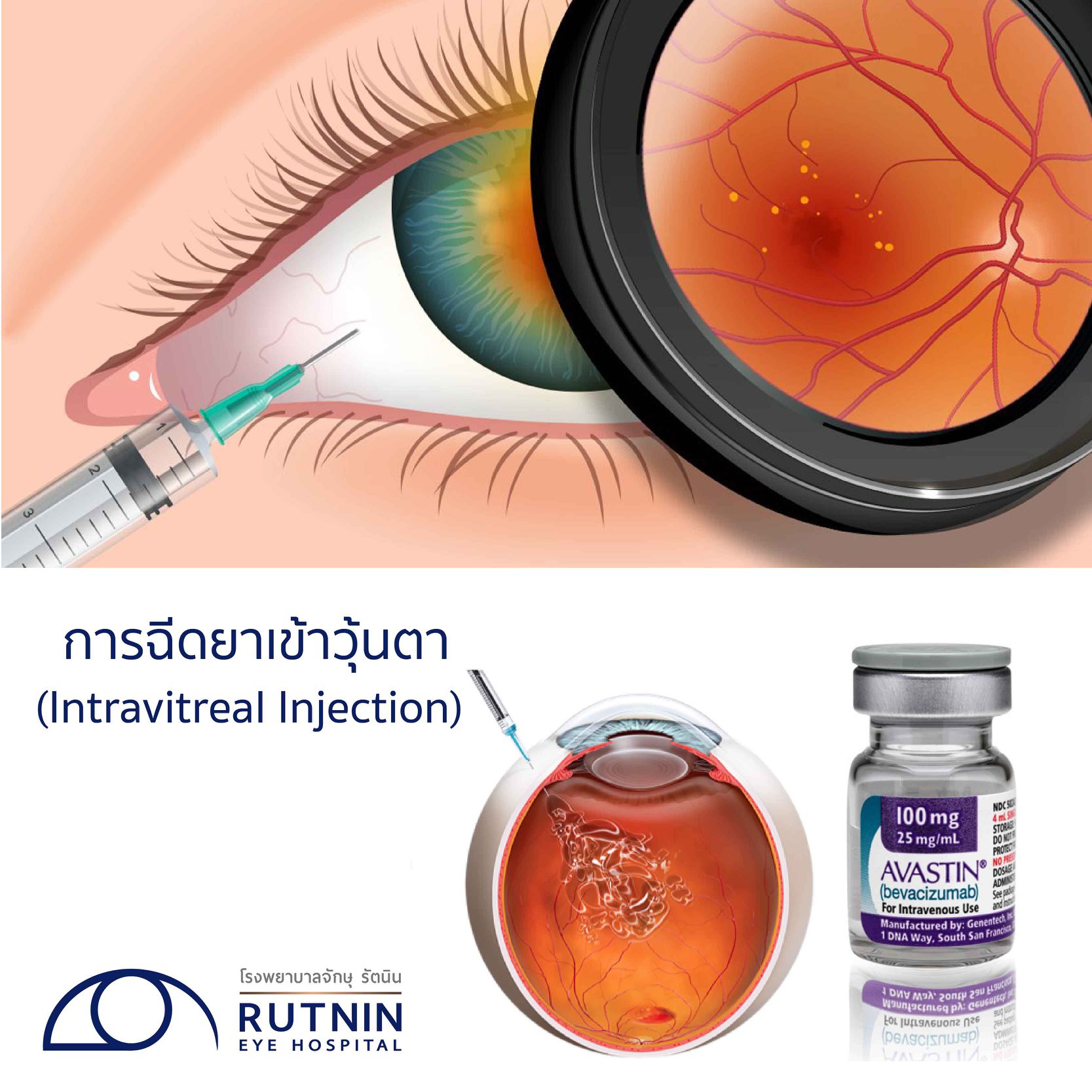 การฉีดยาเข้าวุ้... - Rutnin Eye Hospital โรงพยาบาลจักษุ รัตนิน | Facebook