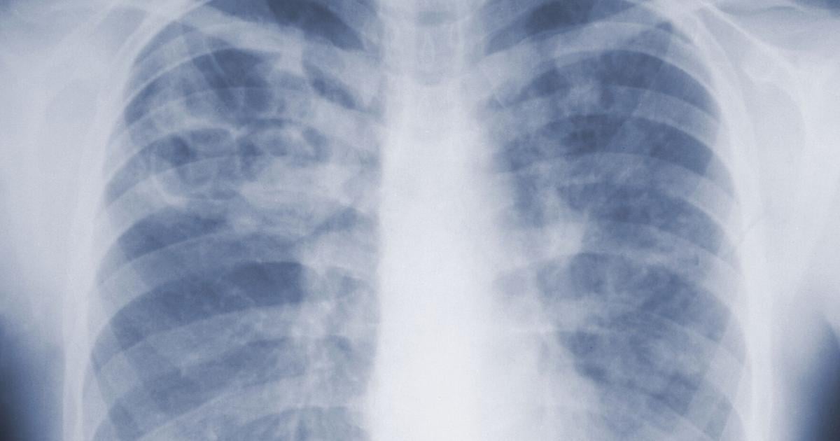 can glutathione cause heart attack Too Much Be Harmful? Understanding the Balance of This Powerful Antioxidant can glutathione damage the kidney