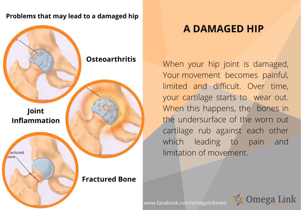 A damaged hip. Learn more and... - Omega Link Medical | Facebook