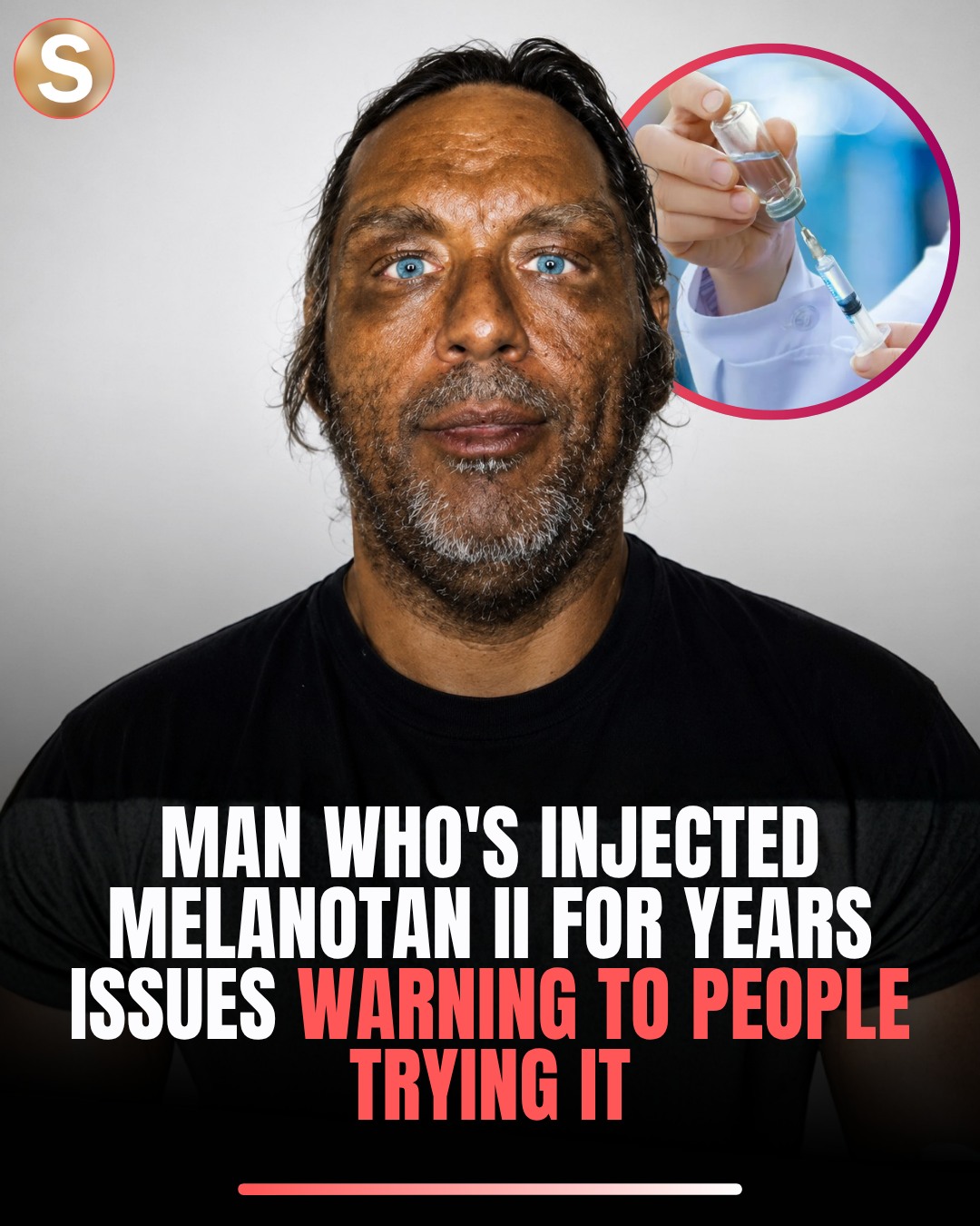 melanotan 2 death Dermatologists are warning against the viral “Barbie drug” tanning injections (Melanotan II/MTII), saying the unregulated peptide can come with side effects like nausea, facial flushing, sexual side effects, and even injection-site abscesses gummi plus Packaging:125 mL White Bottle Can BPC-157 Be Taken