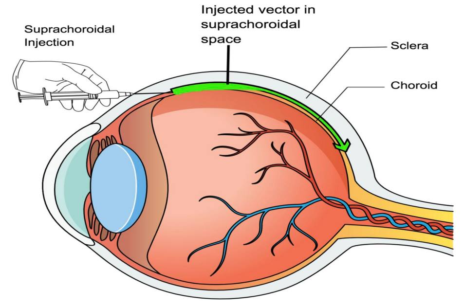 Gene therapy for inherited corneal diseases