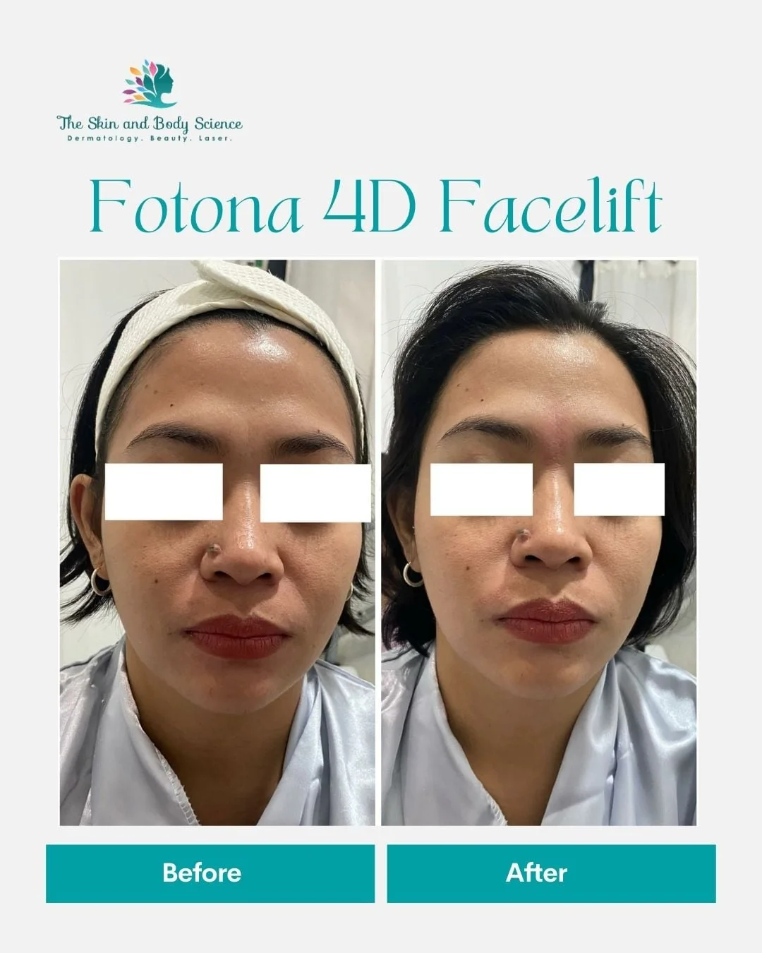 The Skin - Tattoo Removal with Revlite This procedure offers minimal ...