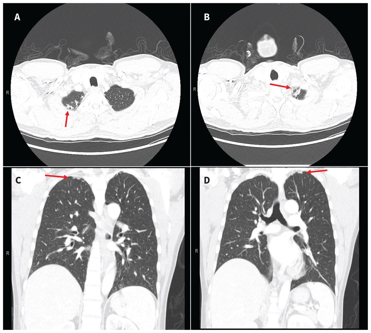 Dr. Muhammed - Computed tomography scans of the lungs of a 47-year-old ...