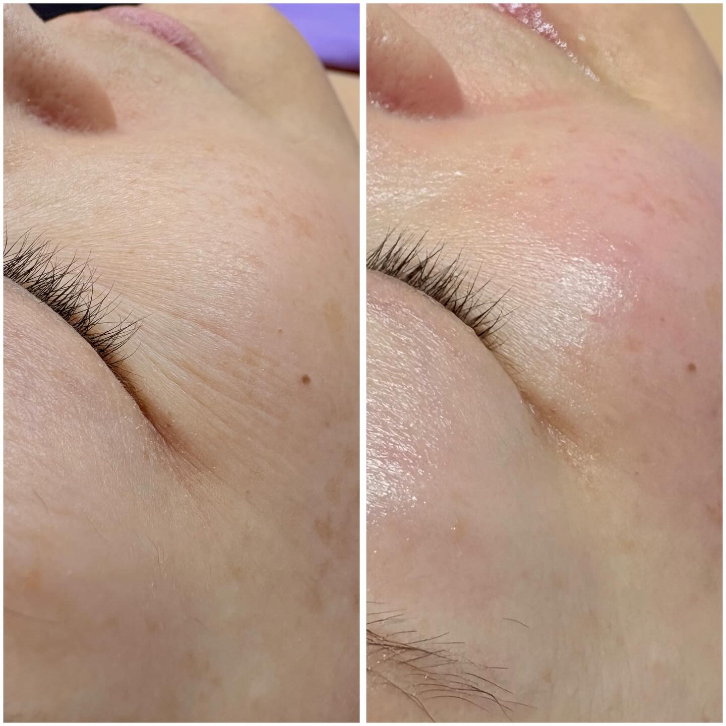 recommend something convenient after tirzepatide skin changes. What to Expect Before and GLP-1 / Tirzepatide & Skin