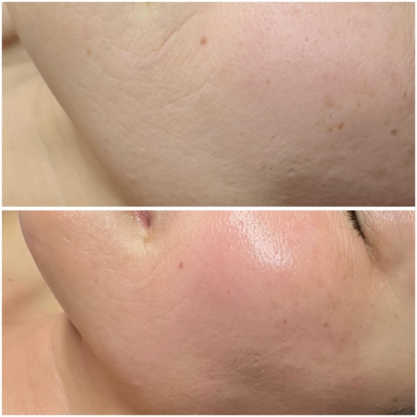 glp 1 causing acne GLP-1 receptor agonists associated with vulgaris in women GLP-1 / Tirzepatide & Skin
