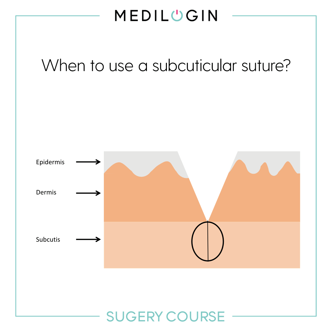 When to use a subcuticular... - MEDILOGIN: Medical Academy