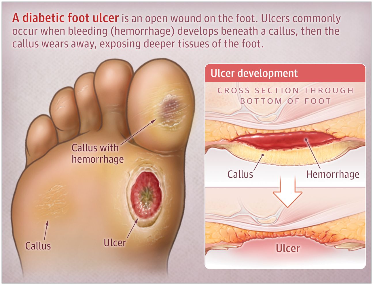 Diabetic Foot Ulcers: Life-Threatening Issue in Need of Help