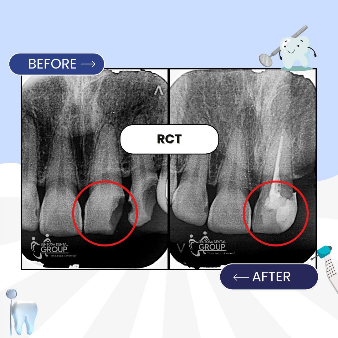 Klinik - RCT | Rawatan Akar Siapa yang perlu dapatkan rawatan RCT ini ...
