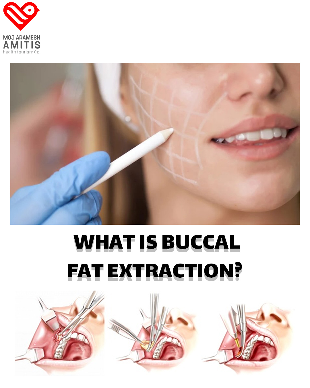 amitis-english-what-is-buccal-fat-extraction-buccal-fat-facebook