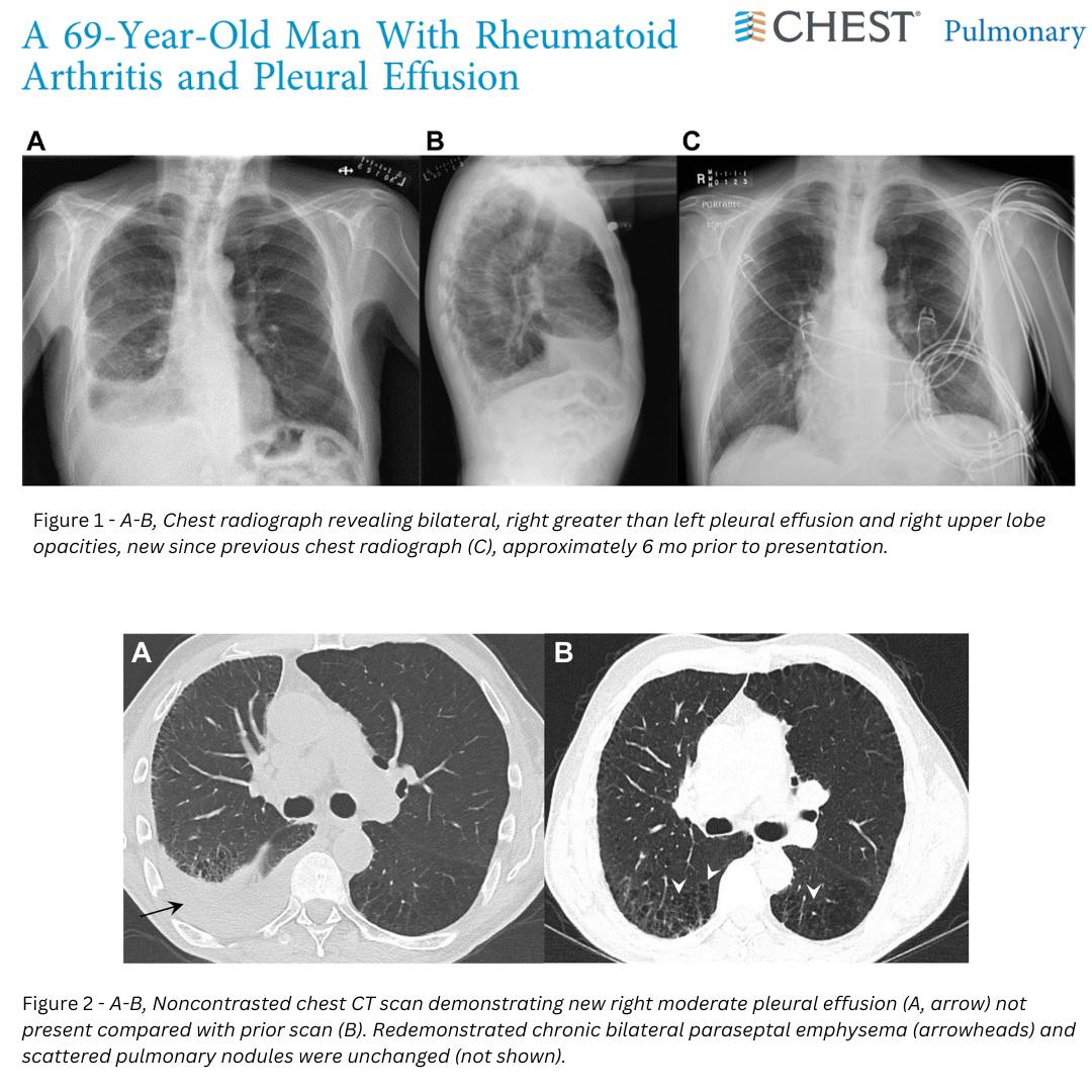 A 69-Year-Old Man... - American College of Chest Physicians
