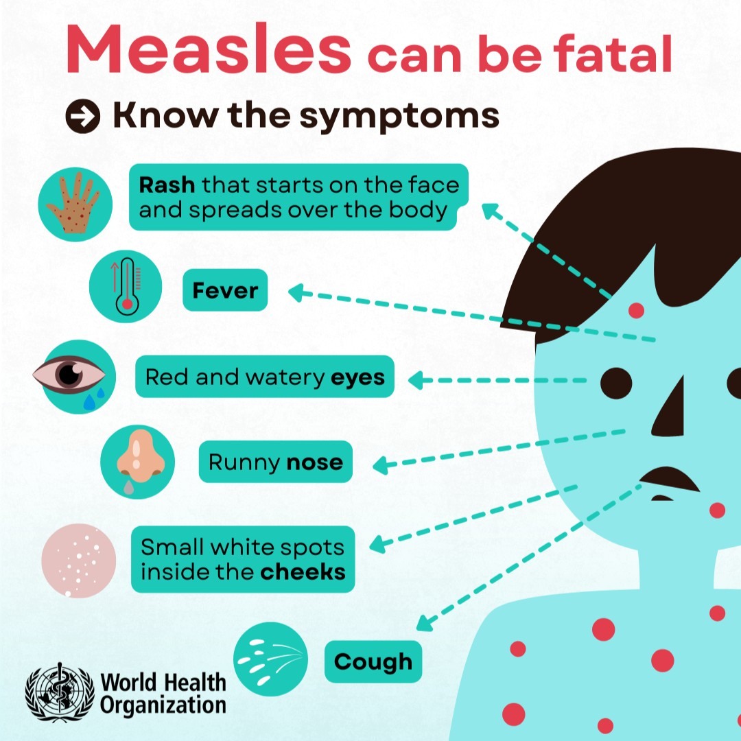 Measles can be fatal. Do you know its symptoms? 🔴 Rash that starts on the face and spreads over the body 🔴 Fever 🔴 Cough 🔴 Red and watery eyes 🔴 Small