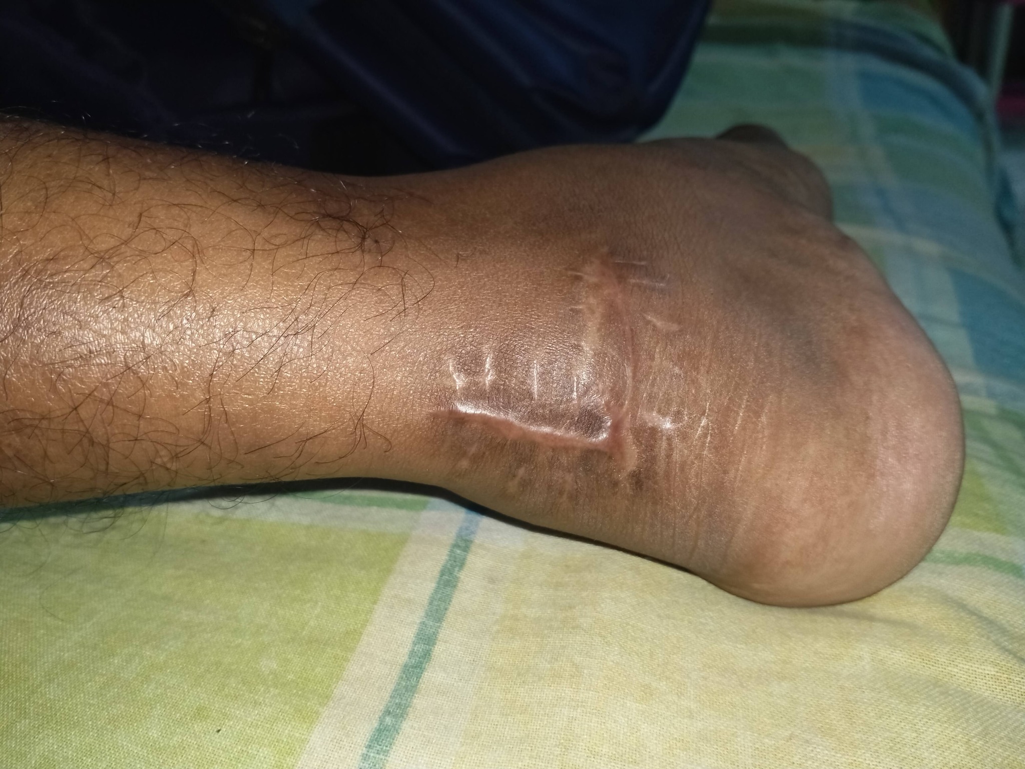 bpc 157 achilles tendon Has anyone used for healing? Ever Forward Radio | BPC-157