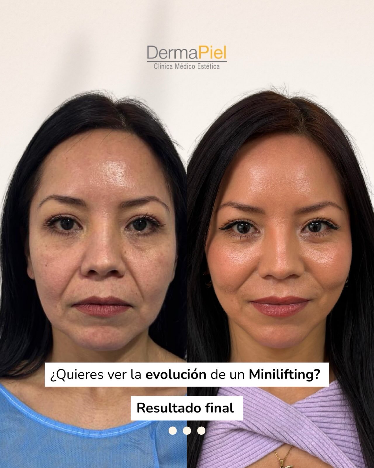 l carnitina inyectable resultados Carnitina, un movilizador de grasas? L-Carnitina, Qu es? Para qu