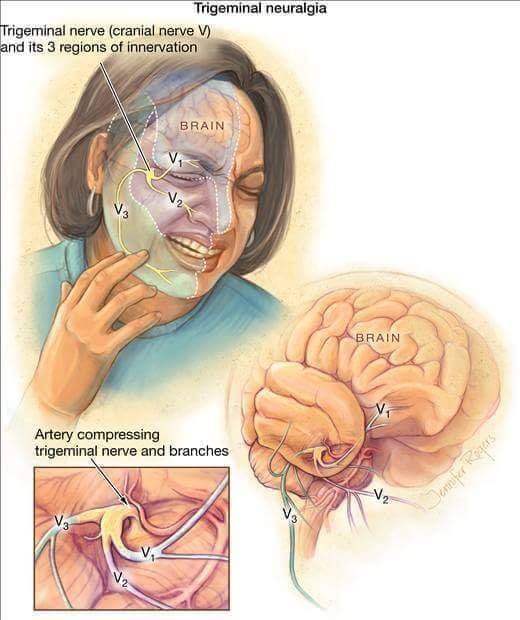 Vitamin B12 injections for trigeminal neuropathic pain?