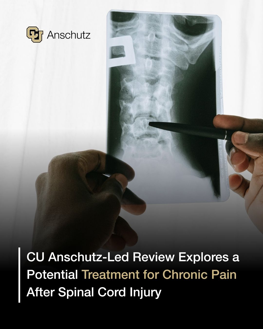 Did bullet removal improve spinal cord injury recovery?