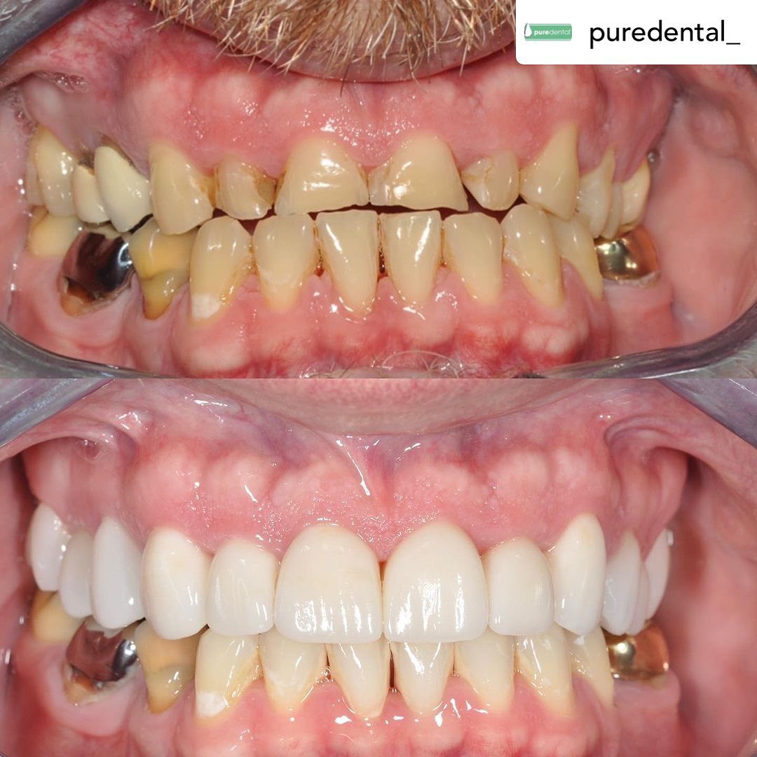 Matrix Dental Laboratory - Wow! Check out this complete smile makeover ...