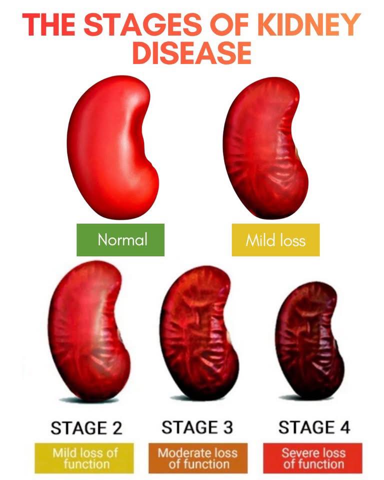 Dr. Muhammed - ️The 5 Stages of Kidney Disease ️ ️Chronic kidney ...