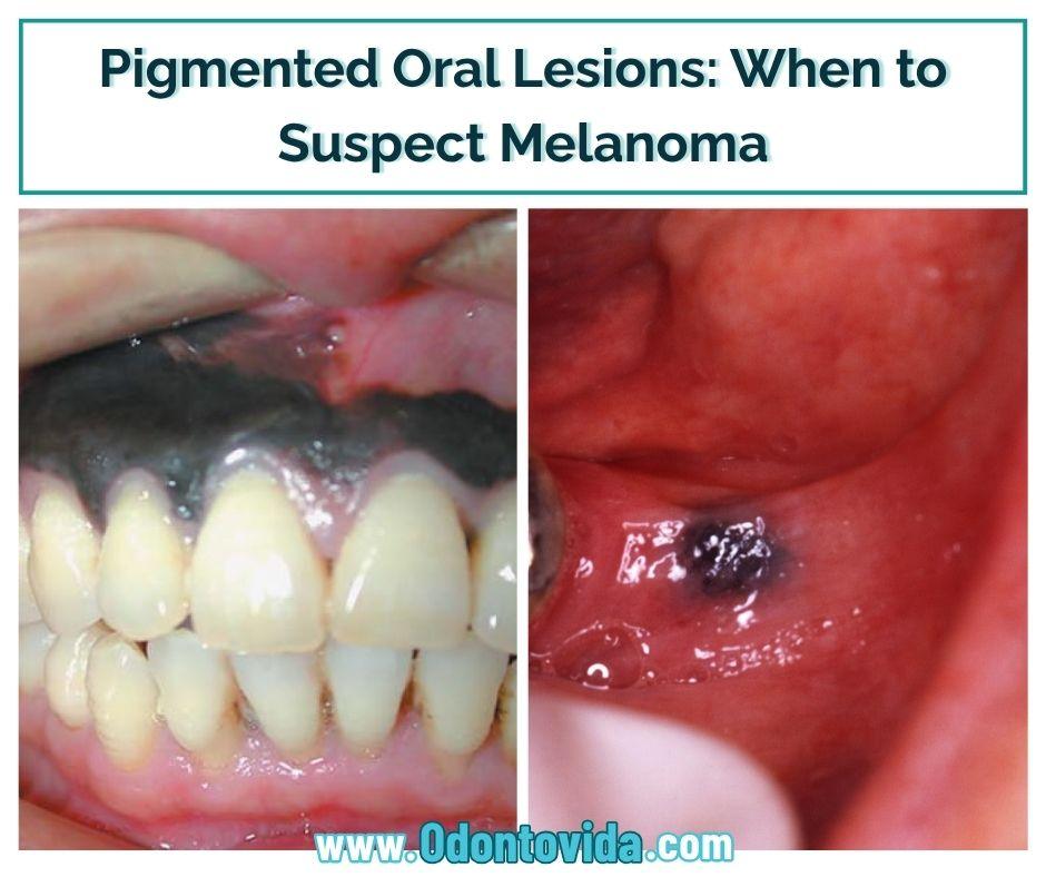 macula melanotica oral ✓ Pigmented Lesions: When to Suspect Melanoma Pigmented oral lesions encompass a wide spectrum of entities ranging from benign physiological conditions to life-threatening malignancies such as oral melanoma. Early recognition of 🚨 𝐓𝐡𝐢𝐧𝐤 𝐁𝐞𝐟𝐨𝐫𝐞 𝐘𝐨𝐮 Amount:10MG folate