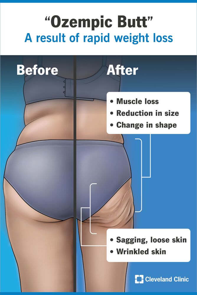 If you take Ozempic® or other semaglutides for weight loss, you're probably prepared to see a difference in your overall appearance. But many people are noticing an unexpected change: 