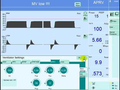 ICU NOTES - Making Adjustments to the APRV Settings...
