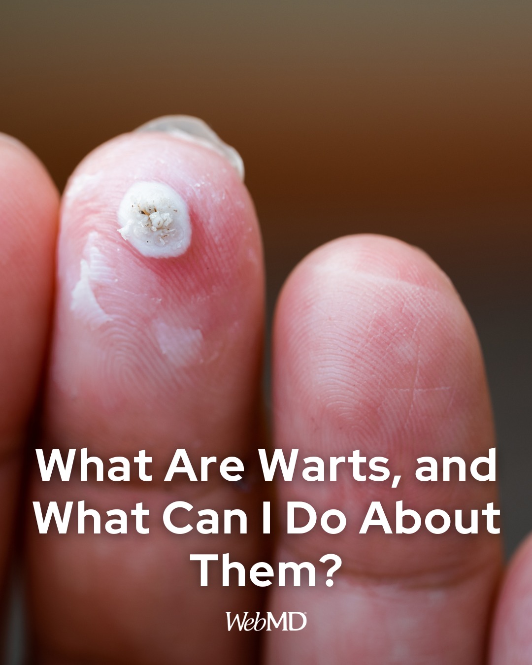 can glutathione remove warts A popular in-office treatment is cryotherapy. The wart is first scraped to the dead upper layers of skin; this helps to make the treatment more effective. The wart is then frozen كريم تفتيح العين